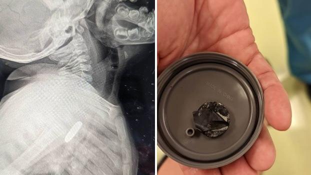 X光檢查發現盧克食道裡有異物(左)，醫生將其取出，發現是膠帶包住的鈕扣電池(右)。(互聯網)