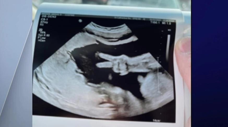 女兒在媽媽的肚裡突然展示V字手勢，給父母驚喜。(互聯網)