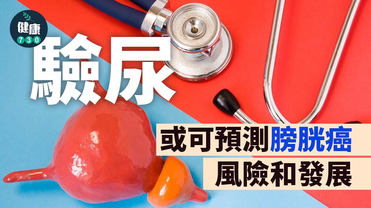 驗尿或可預測膀胱癌風險和發展