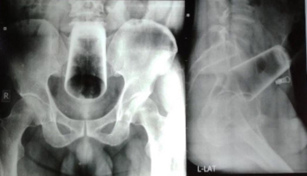 尼泊爾男12厘米高玻璃杯塞肛門，醫生稱多數患者為男性。(網上圖片)