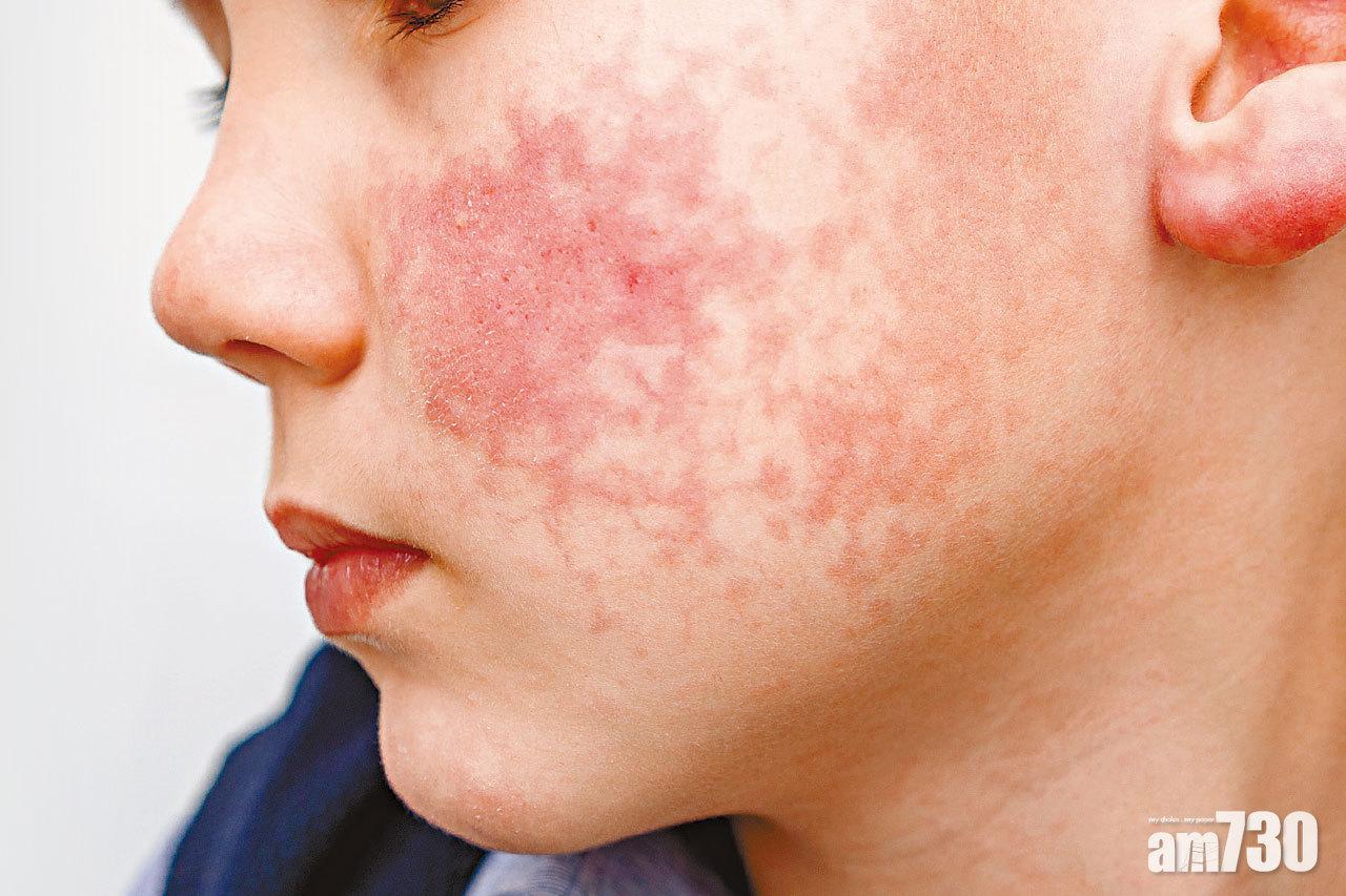 21歲嚴重濕疹青年試藥後皮膚變滑長高20厘米 劉宇隆：嚴重過敏或涉基因出錯