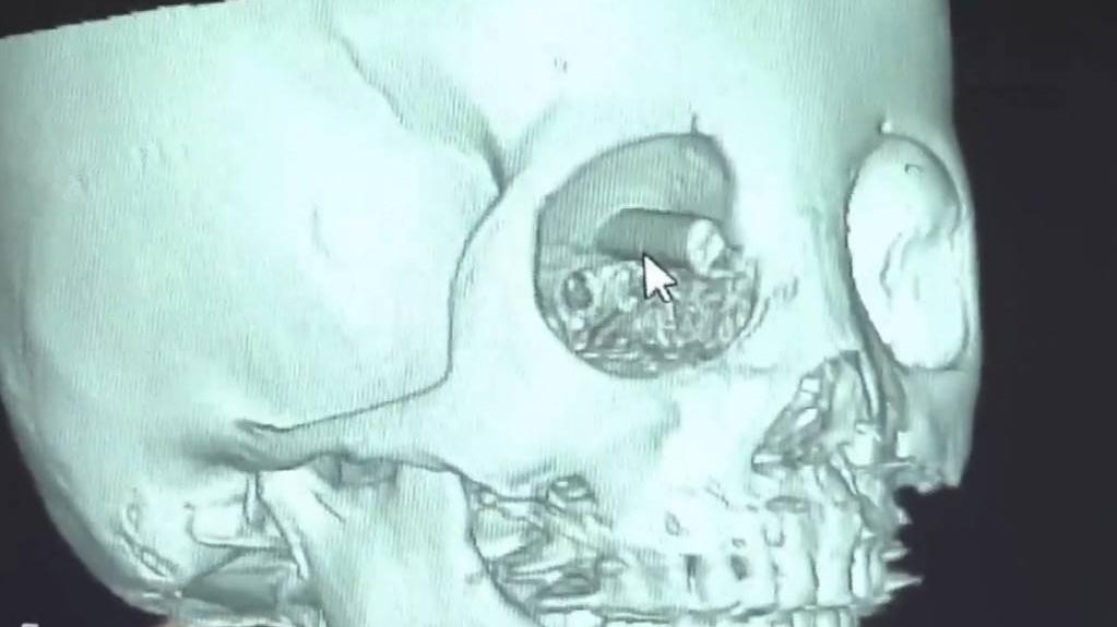 鄭州6歲女童筷子插眼入腦9cm　奇蹟無大礙