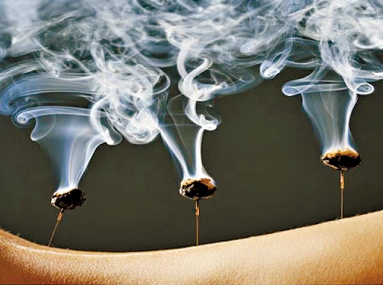 推拿配合溫針灸治療膝關節炎