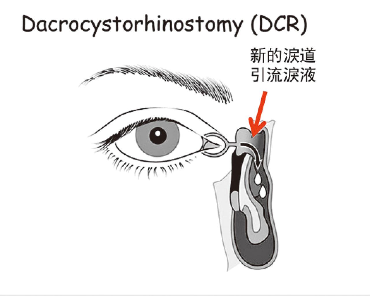 鼻淚管閉塞的治療(下)