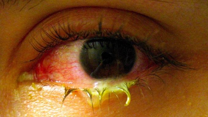 美眼藥水受細菌感染 最少3死8失明 4人須摘取眼球