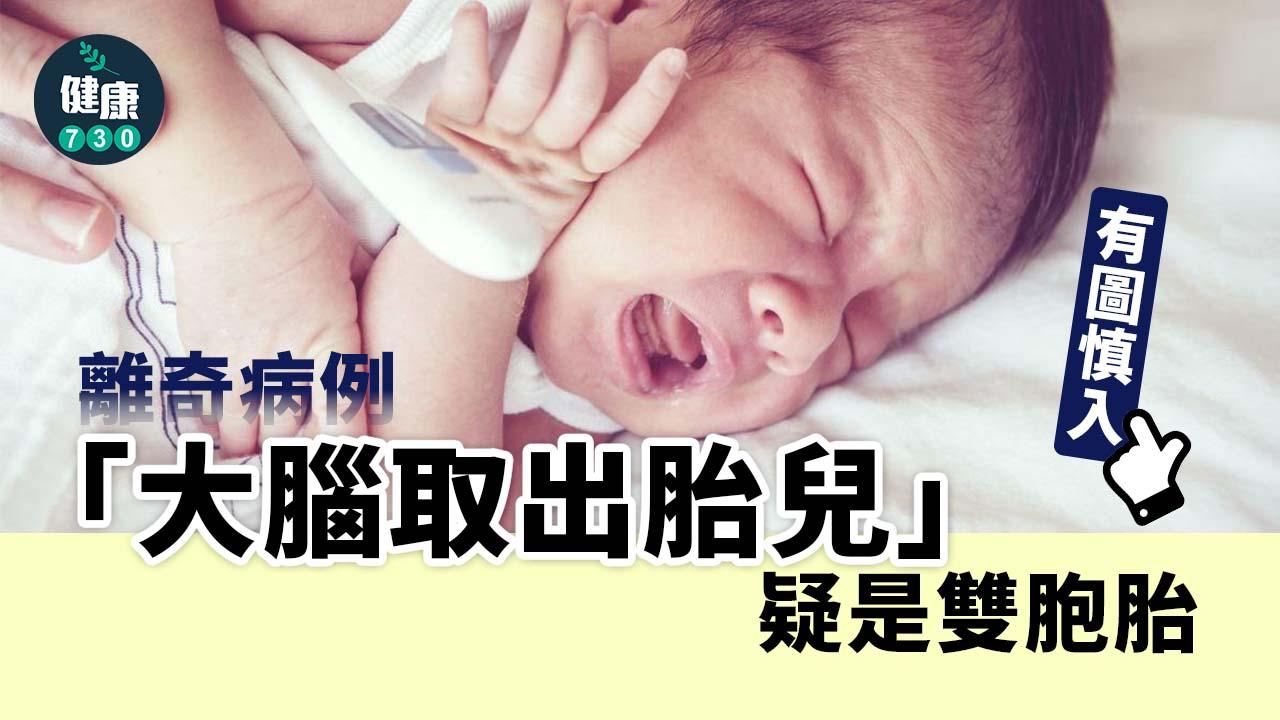 有圖慎入｜離奇病例！1歲女嬰「大腦取出胎兒」疑是雙胞胎