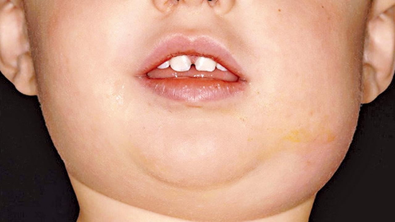 腮腺炎後 何以會不孕不育？