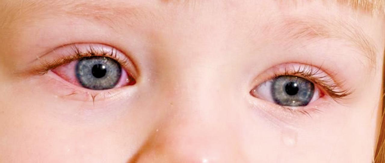 眼睛痕癢難當 是否過敏性結膜炎？