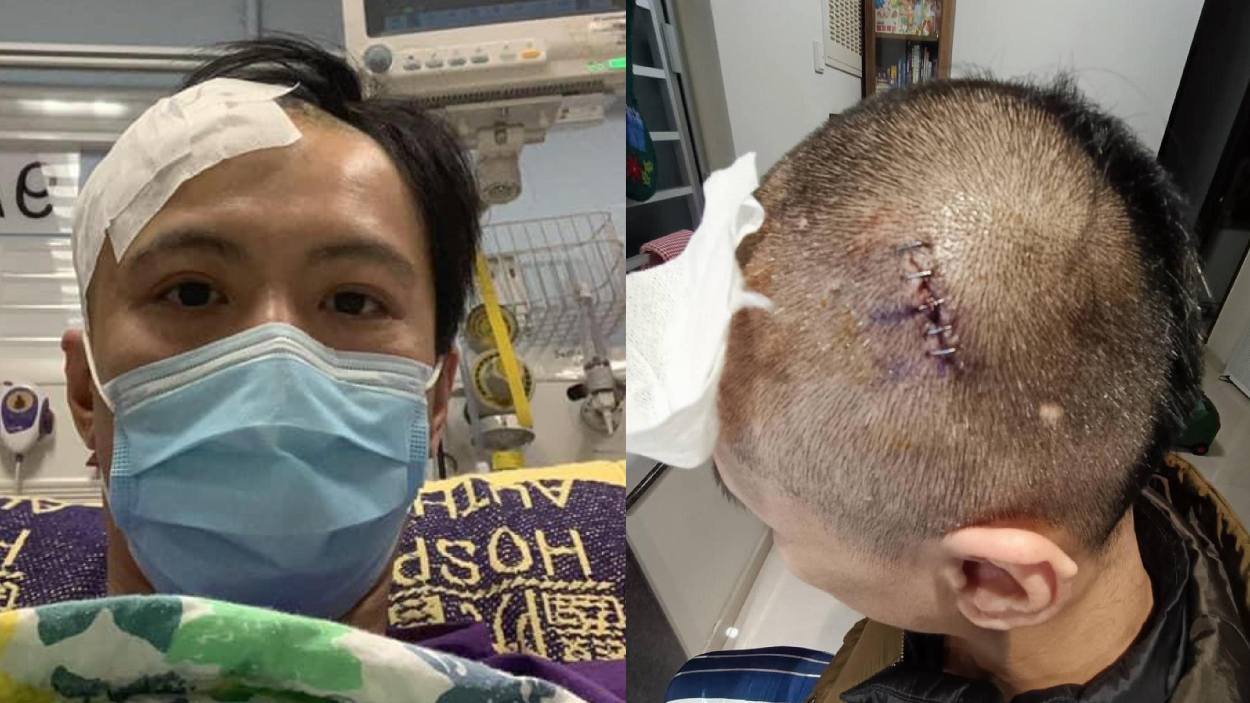 周永恆疑遭內地妻家暴 爆頭縫針傷勢恐怖 