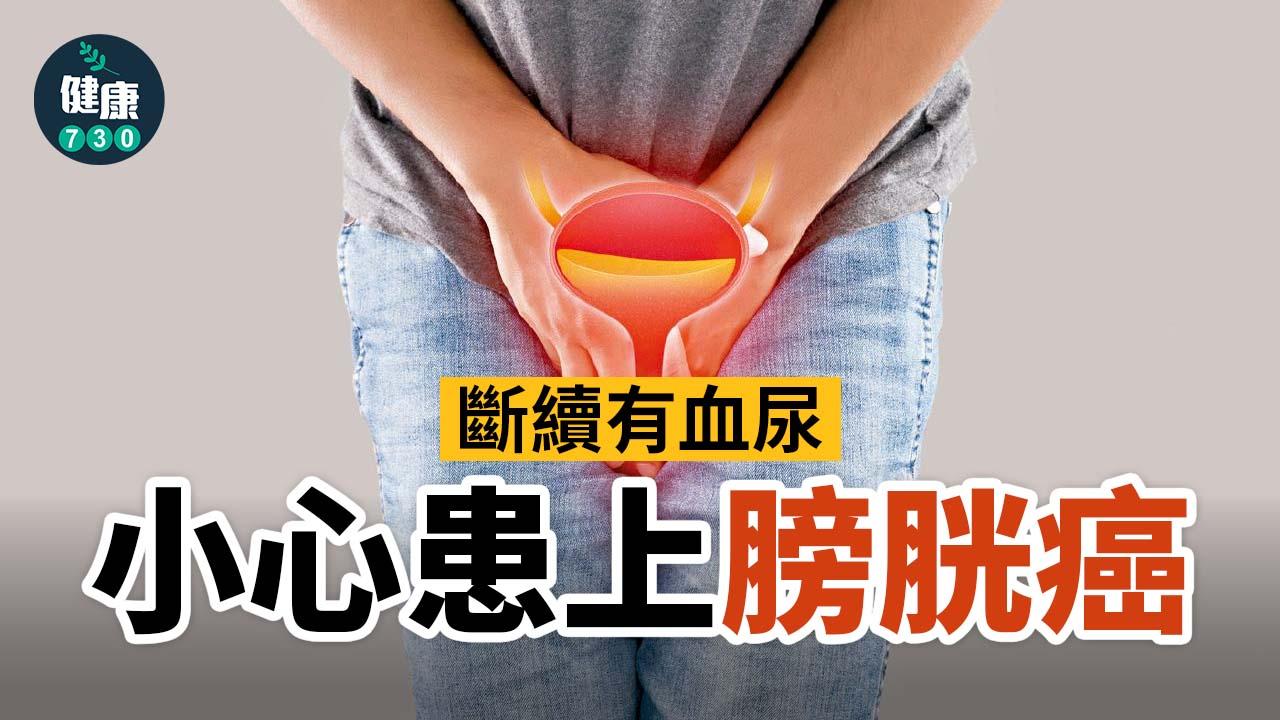 膀胱癌｜斷續有血尿 小心患上膀胱癌