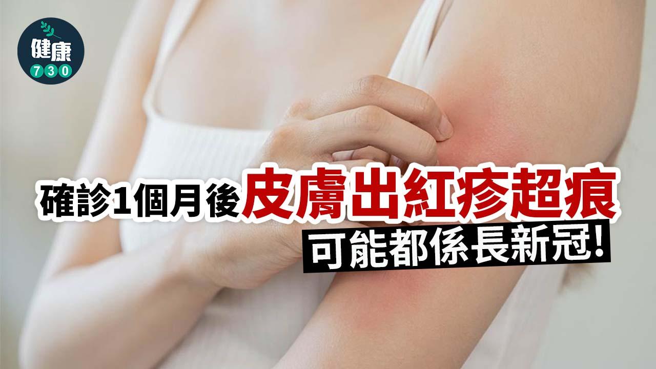 染疫1個月後皮膚突然出紅疹超痕！可能都係長新冠