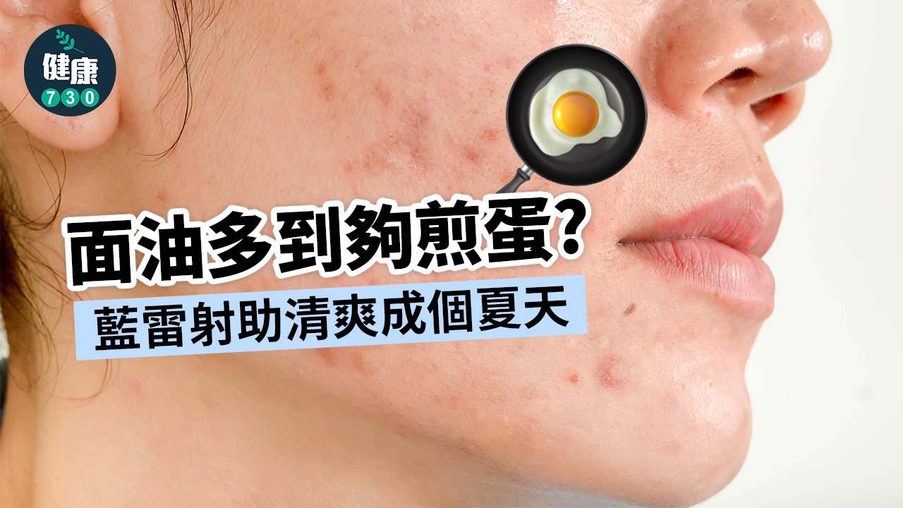 面油多到夠煎蛋？藍雷射助清爽成個夏天