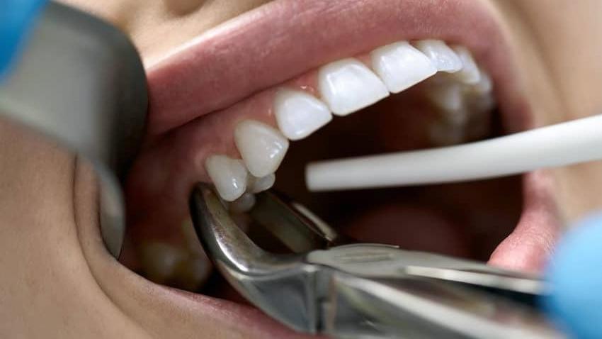 一次過剝12隻牙，泰國六旬翁失血過多死亡。(網上圖片)