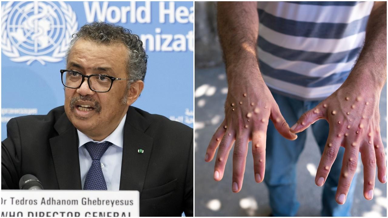 世衞將猴痘剔出國際關注突發公共衞生事件。(資料圖片)