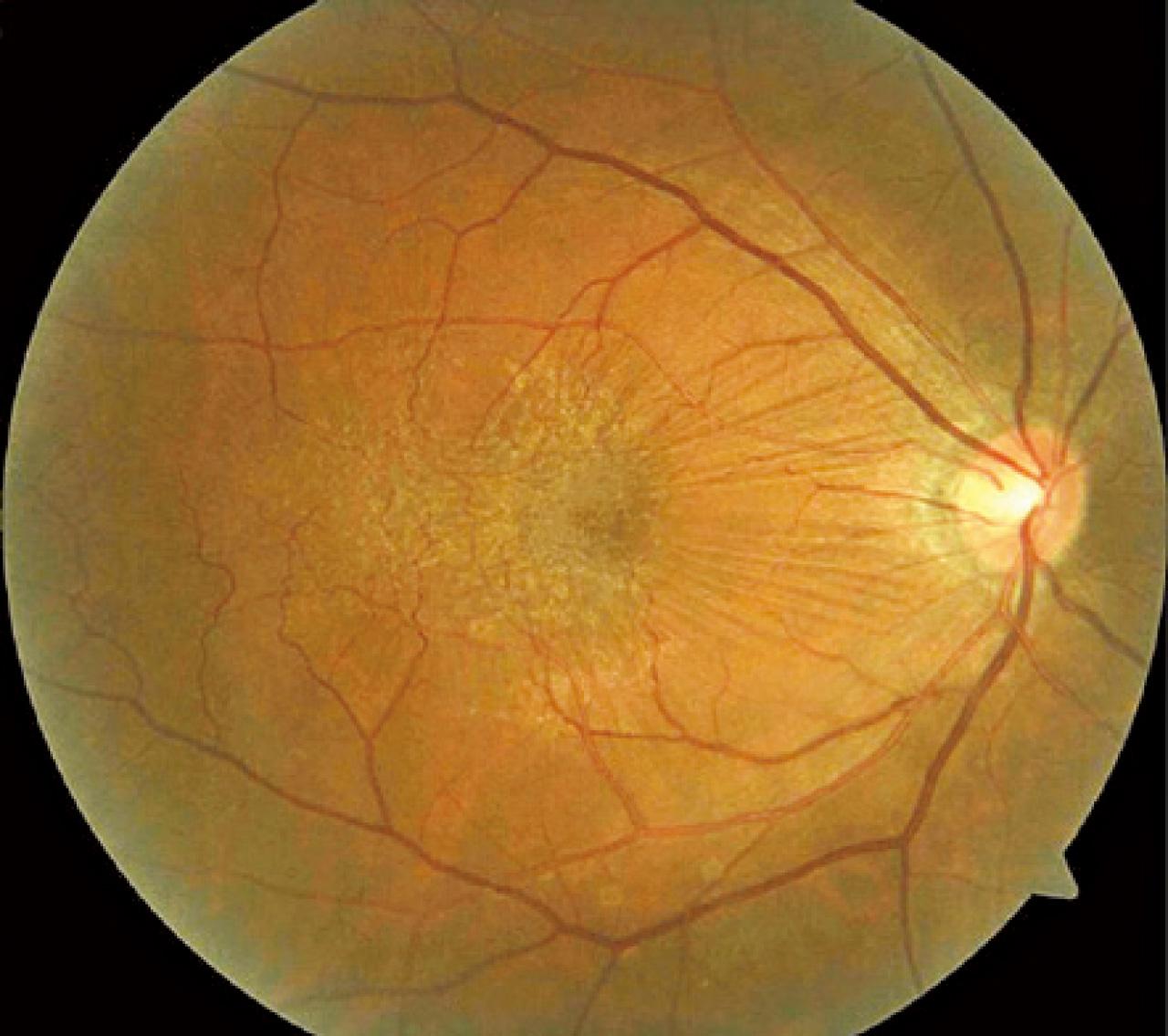 黃斑前膜知多啲