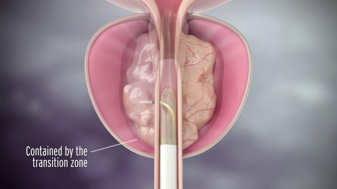 前列腺肥大手術