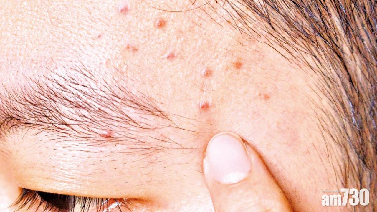 四川男擠暗瘡「流血不止」1小時　用足一卷紙巾止血嚇到面青