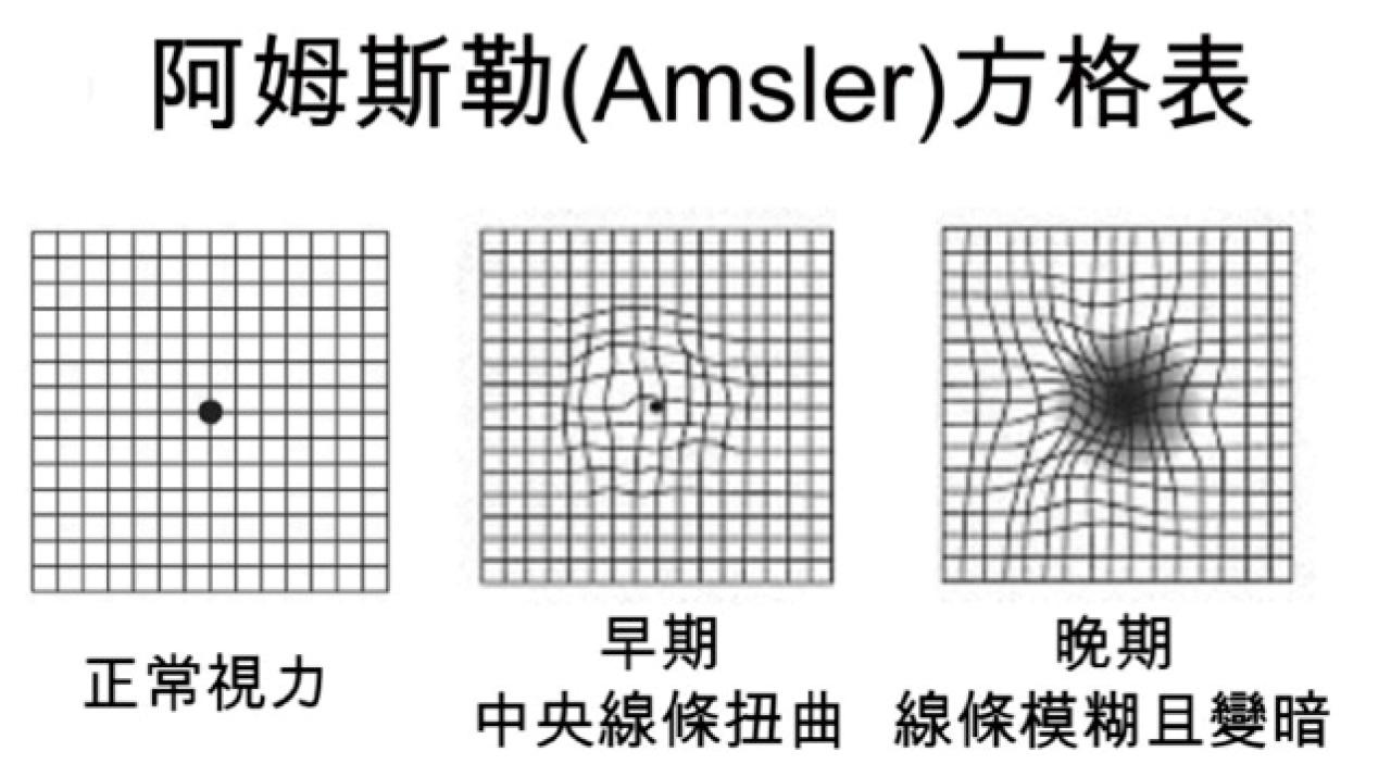 黃斑前膜的診斷和治療(一)