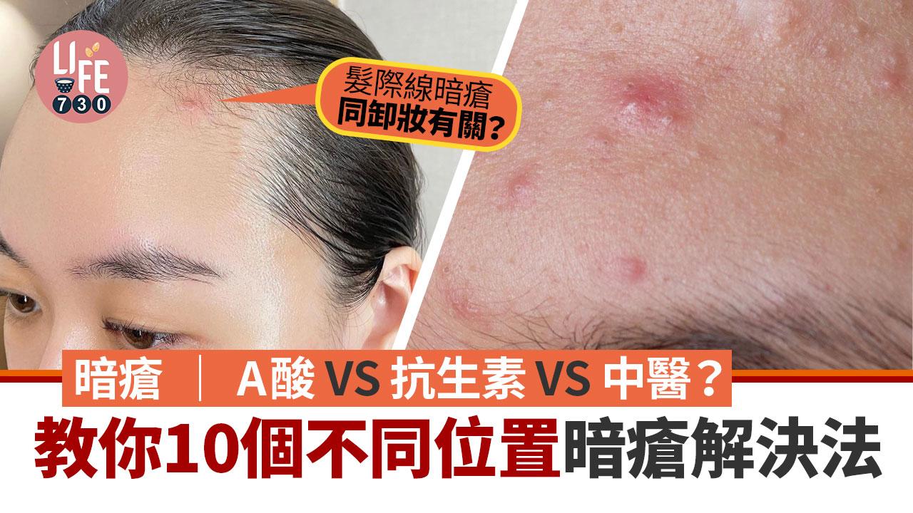 暗瘡｜A酸VS抗生素VS中醫？ 教你10個不同位置暗瘡解決法 髮際線同卸妝有關？