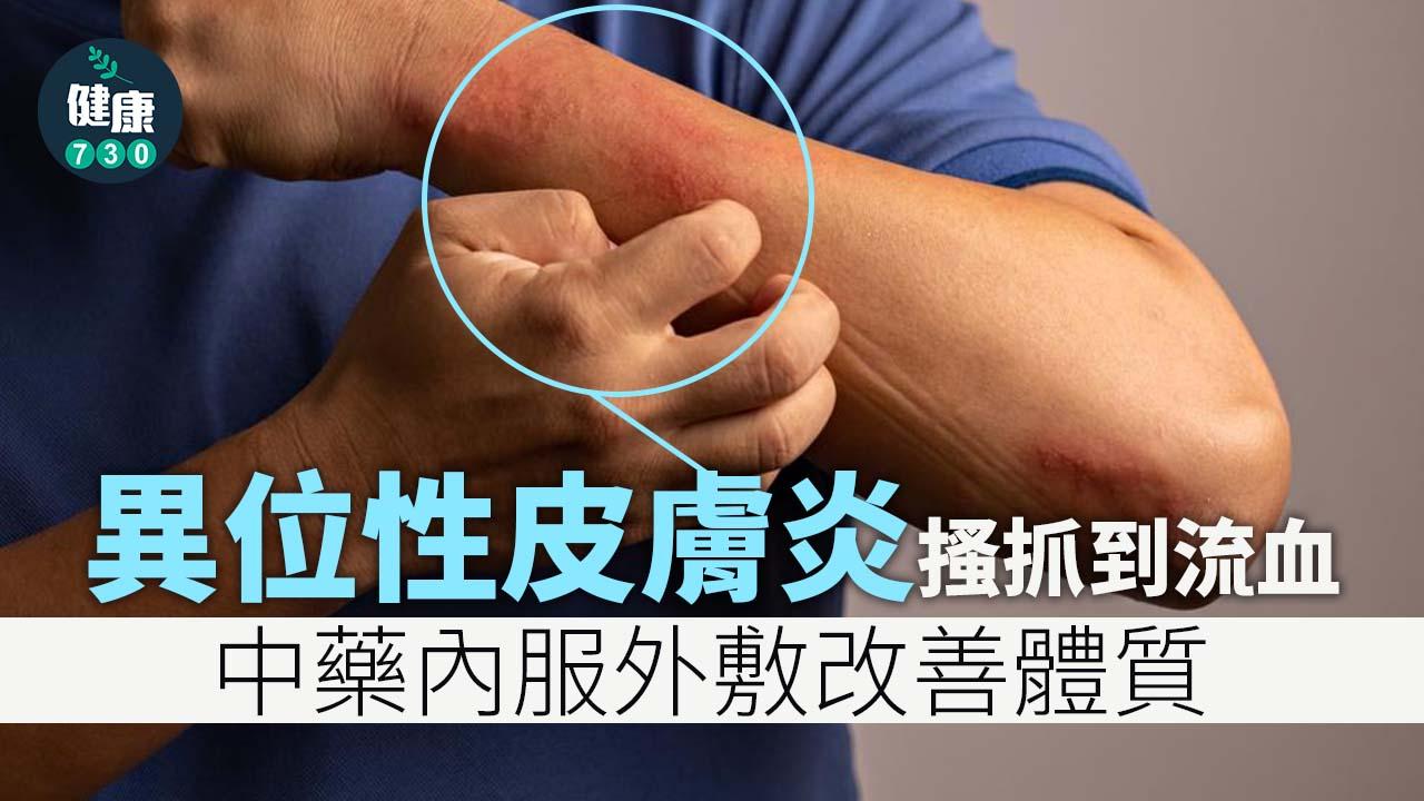 濕疹｜異位性皮膚炎搔抓到流血 中藥內服外敷改善體質