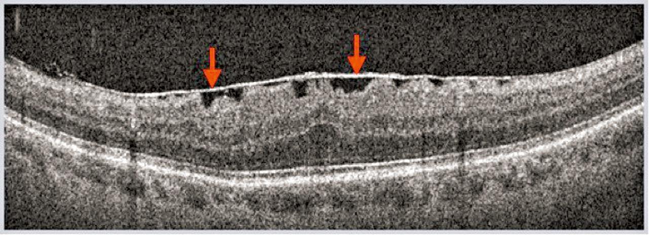 黃斑前膜的診斷和治療(三)