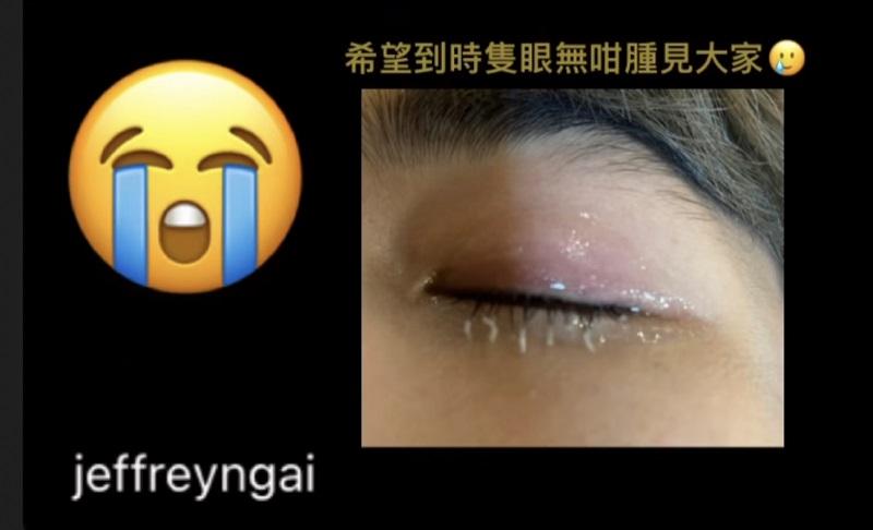 魏浚笙生眼挑針 求網民介紹藥膏