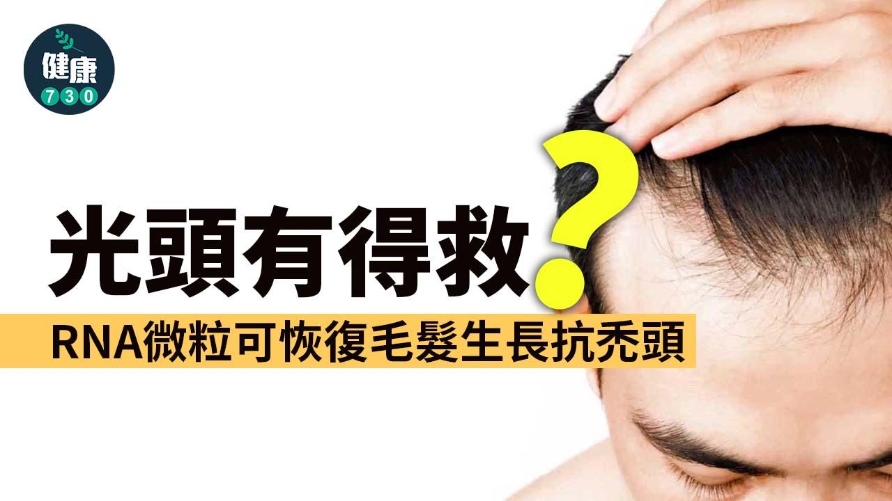 光頭有得救？RNA微粒可恢復毛髮生長抗禿頭