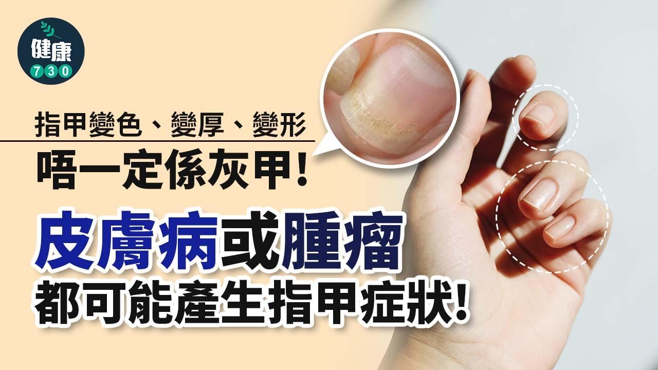 指甲變色、變厚、變形唔一定係灰甲！呢啲原因都可能產生指甲症狀