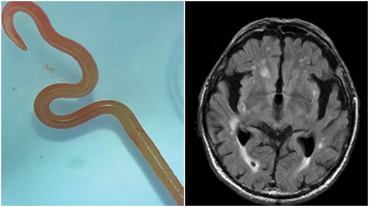 大腦取出8厘米長寄生蟲，醫生：還在蠕動。(X)