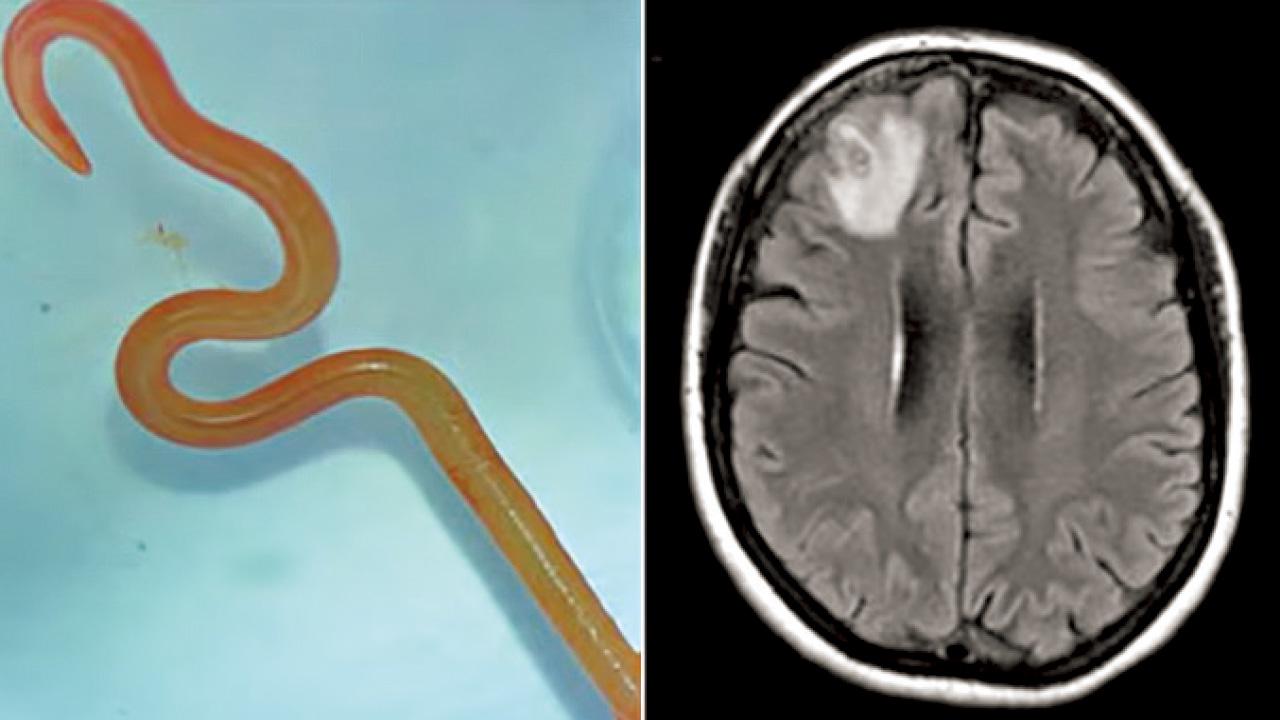 源自蟒蛇 全球首例 澳婦腦部取出8厘米活寄生蟲