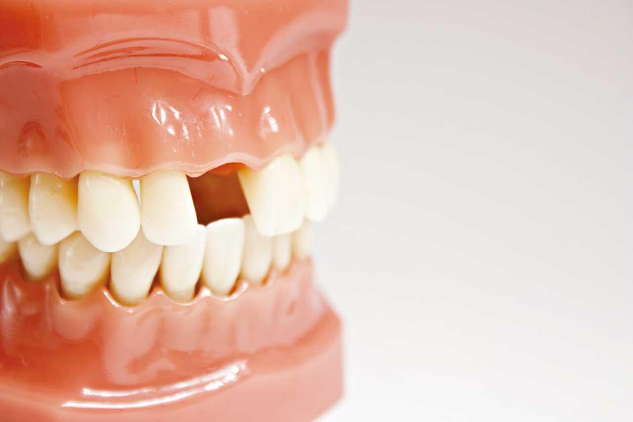 日研究：長者牙少或嚴重牙周病 可加速腦退化