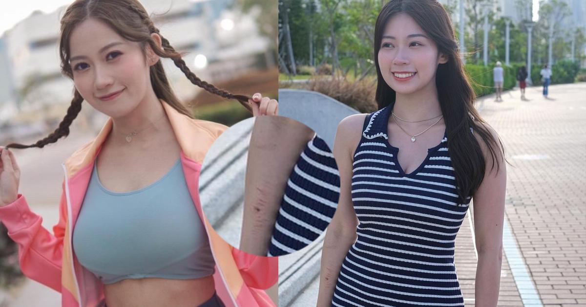 曾志偉愛將左手驚現十條𠝹痕疑自殘 波波黃婧靈︰容易受傷的女人