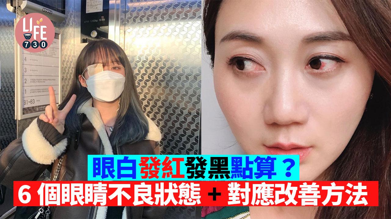 眼睛健康｜眼白發紅發黑？！6個眼睛不良狀態+對應改善方法