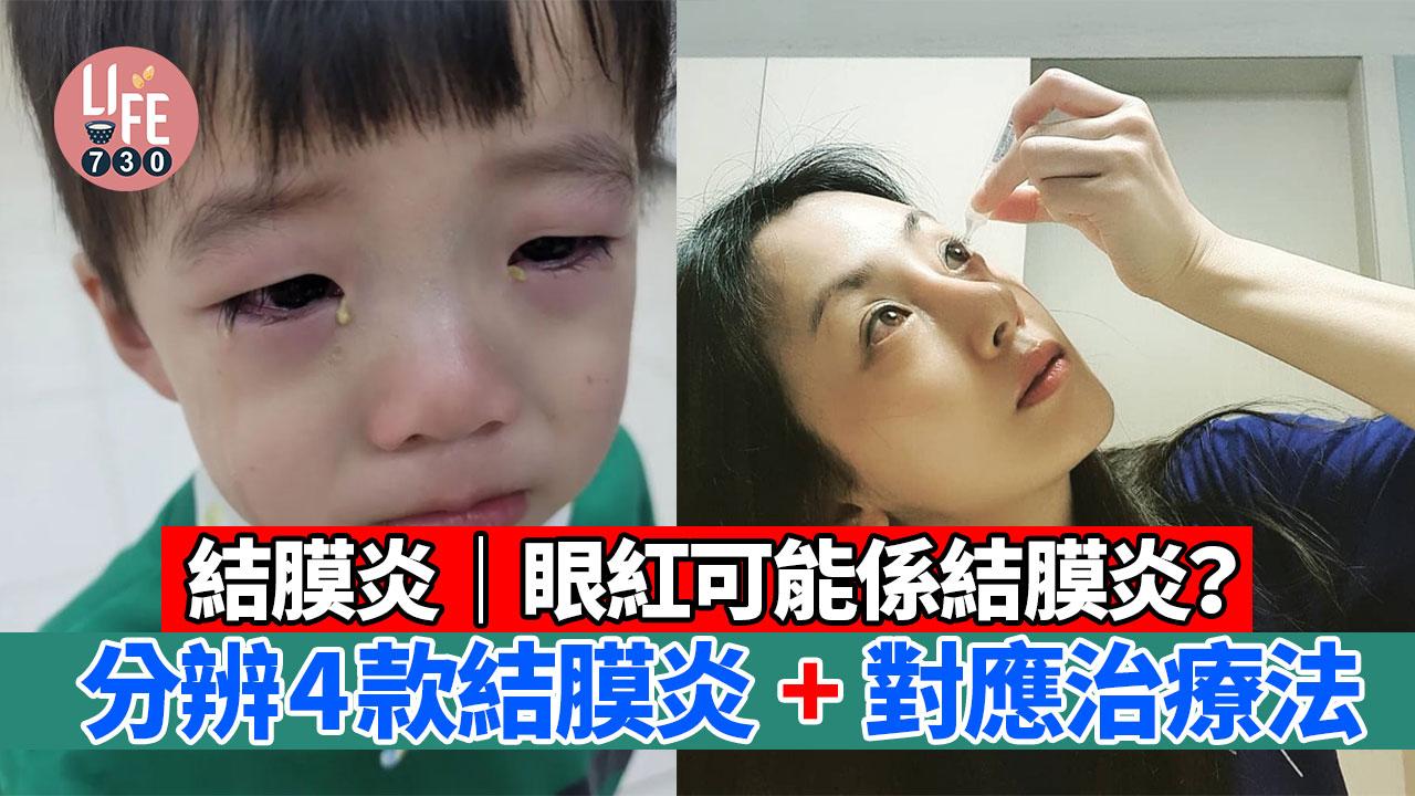 眼紅可能係結膜炎？！分辨4款結膜炎+對應治療法