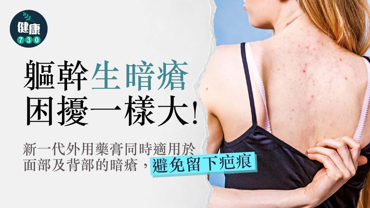 軀幹生暗瘡 困擾一樣大