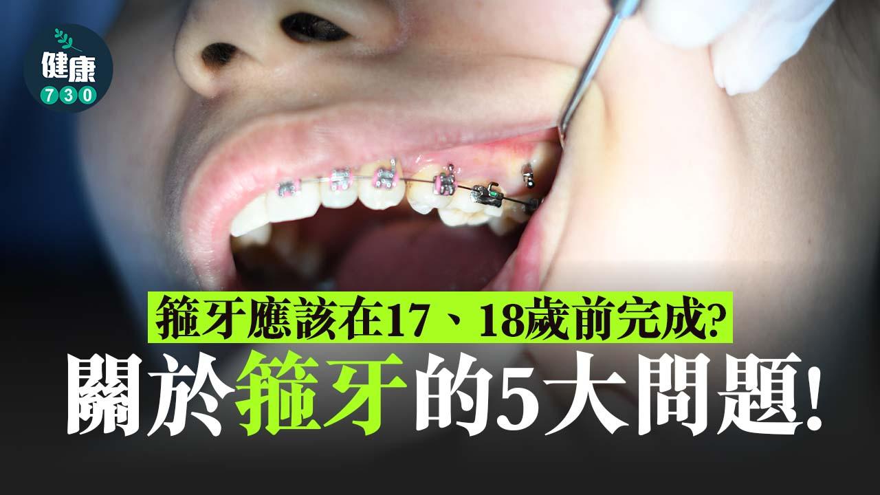 牙齒矯正｜箍牙後要戴一世retainer？關於箍牙的5大問題！