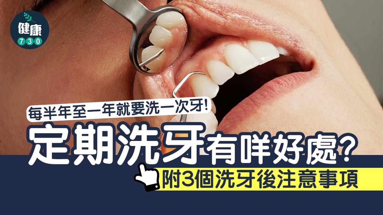 洗牙｜每半年至一年就要洗一次牙！定期洗牙有咩好處？附3個洗牙後注意事項