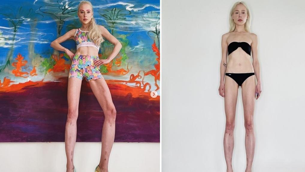 菲舍爾手術後換來一雙長腿。(互聯網)