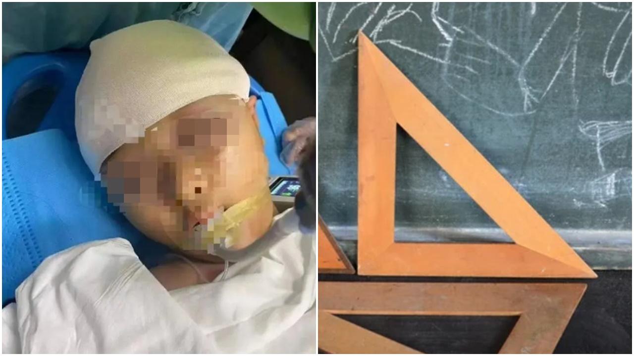 9歲女生遭教師用三角尺打到腦漿溢出，學校偷送院無通知家屬。