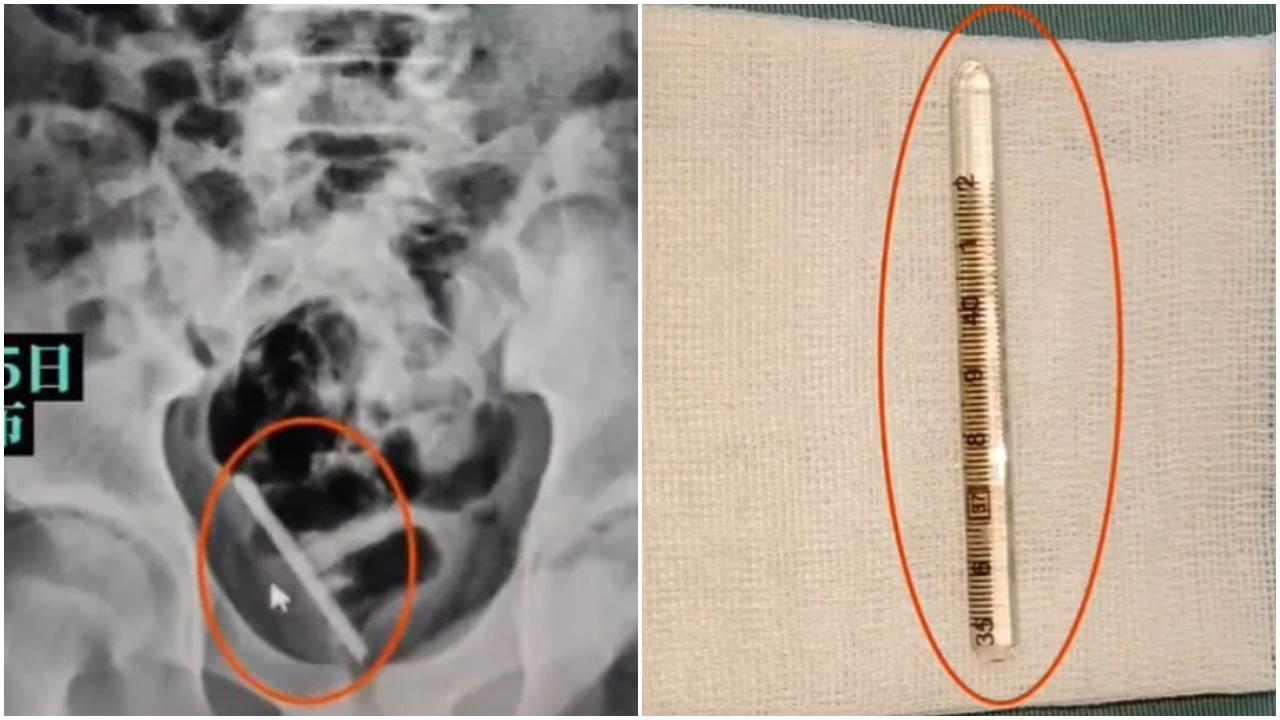 江西10歲男童將探熱針插尿道不慎折斷，網民：性教育刻不容緩。(微博)