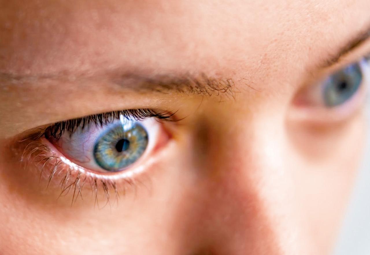 甲狀腺眼病 凸眼不容忽視