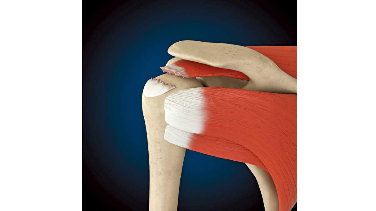 肩膀旋轉肌腱撕裂 膊頭痛症元兇 