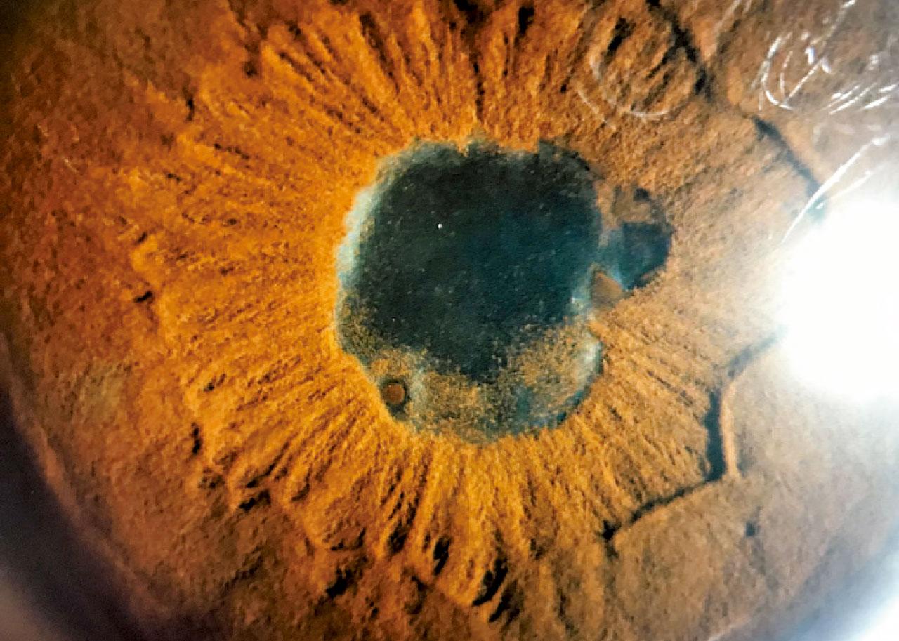 葡萄膜炎：眼睛發炎病