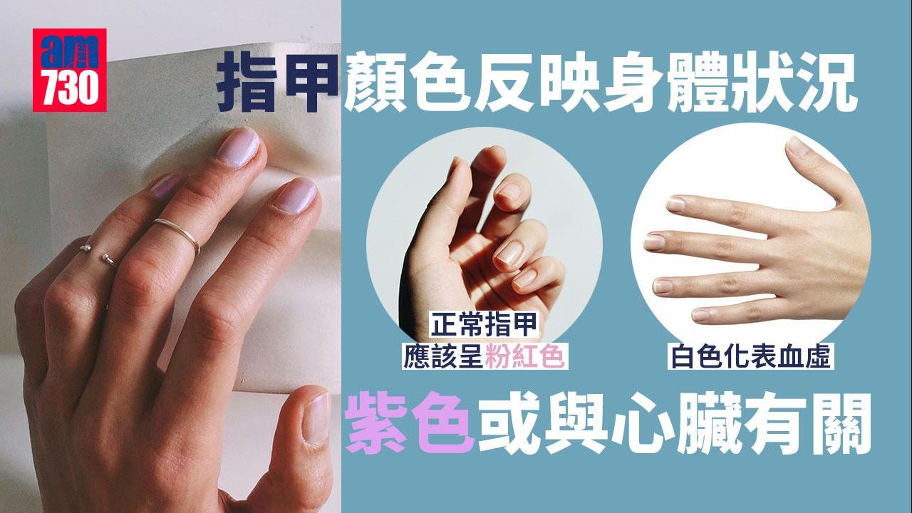 指甲偏白/偏紫反映健康狀況？心臟病/貧血警號不可不察