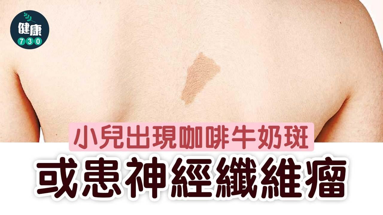 小兒出現咖啡牛奶斑 或患神經纖維瘤