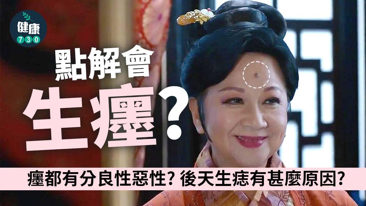 癦｜點解會生癦？天生還是後天形成？癦都有分良性惡性？