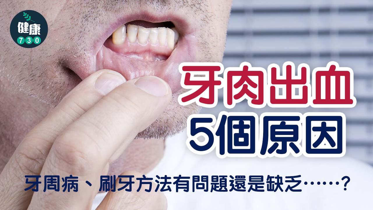 牙肉出血5個原因 牙周病、刷牙方法有問題還是缺乏……？