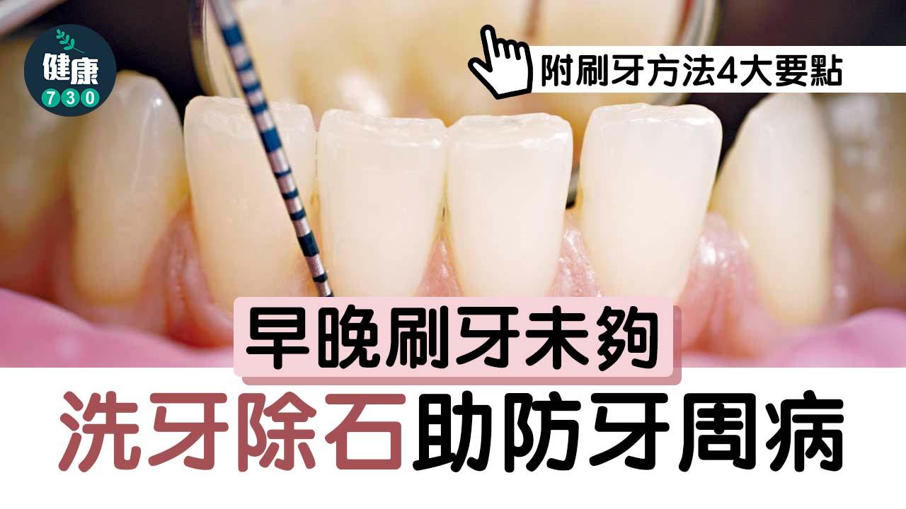 早晚刷牙未夠 洗牙除石助防牙周病