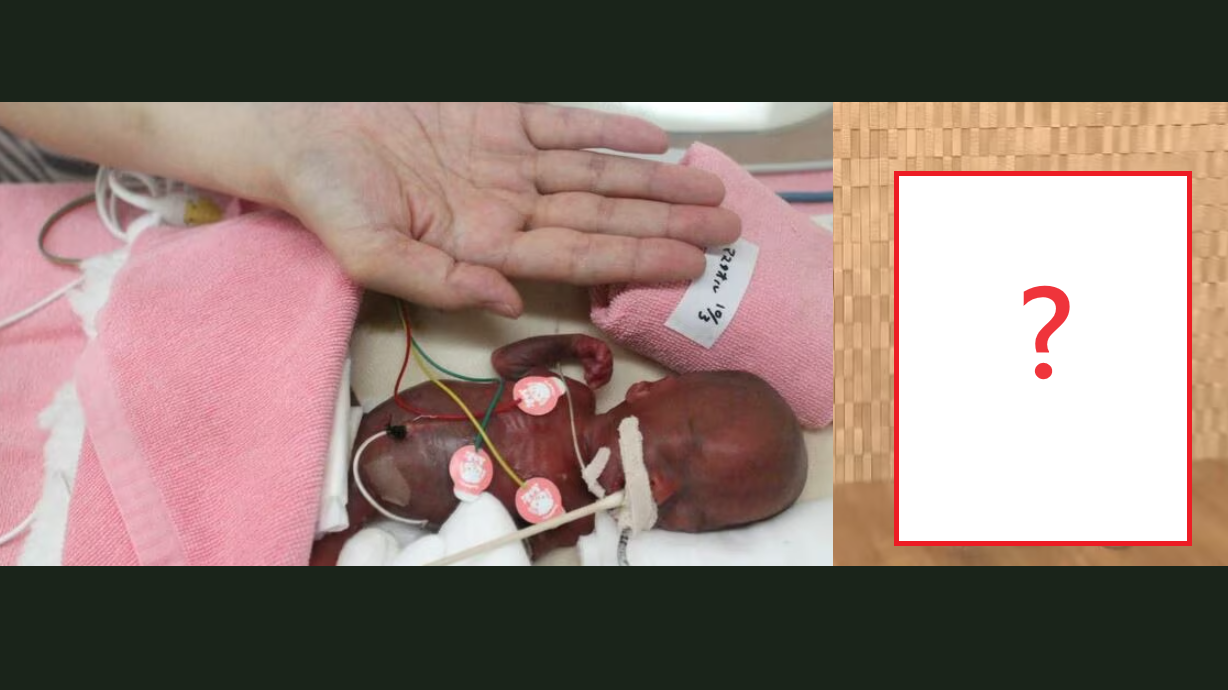 細如手掌「全球最小嬰兒」僅重258克 如今5歲近況曝光(多圖)