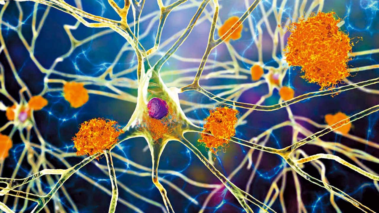 阿茲海默症的生物標記與預防